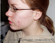 acne före laserbehandling