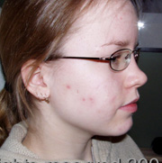 acne efter laserbehandling
